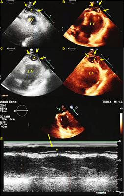 Case Report: Left ventricular apical hypertrophy in a patient with Leopard syndrome mimicking a cardiac tumor: a diagnostic challenge resolved by multimodality imaging